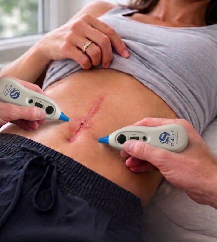 Dolphin MPS Scar Release Therapy - Old Belly Scar